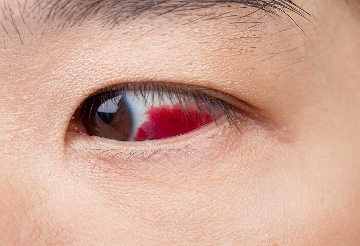 Göz Travmaları (Göz İçi Kanamalar, Retinal Yırtıklar)